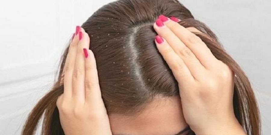 مكونات طبيعية من مطبخك لعلاج القشرة - تليجراف الخليج